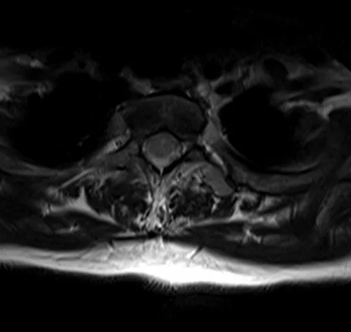 mri t spine axial t2 image 1 - MRI