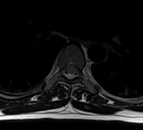 mri t spine axial t2 image 2 - MRI