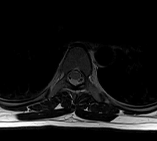 mri t spine axial t2 image 3 - MRI