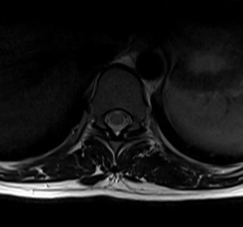 mri t spine axial t2 image 4 - MRI