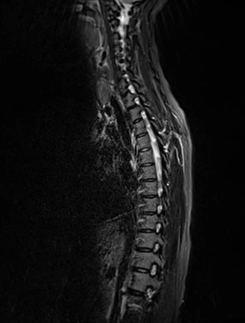 mri t spine sagittal stir image 1 - MRI