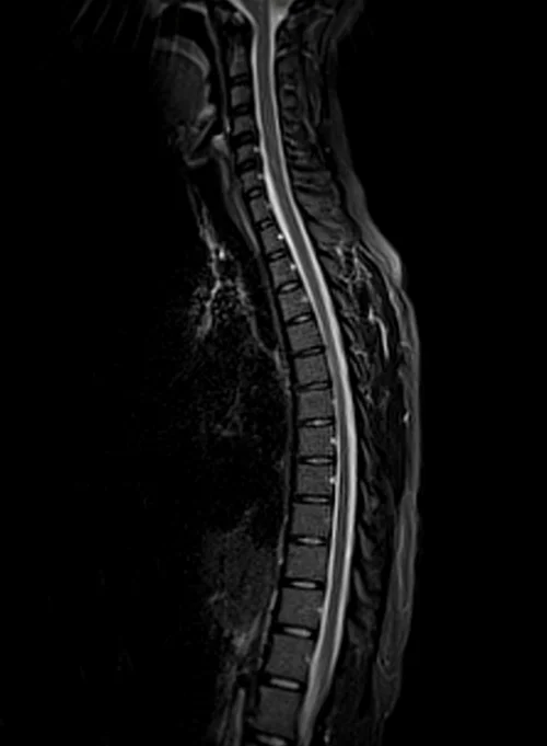 mri t spine sagittal stir image 2 - MRI
