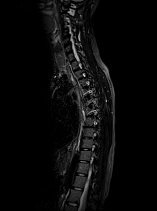 mri t spine sagittal stir image 3 - MRI