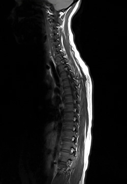 mri t spine sagittal t1 image 1 - MRI