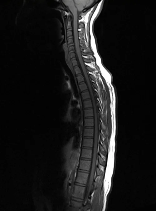 mri t spine sagittal t1 image 2 - MRI