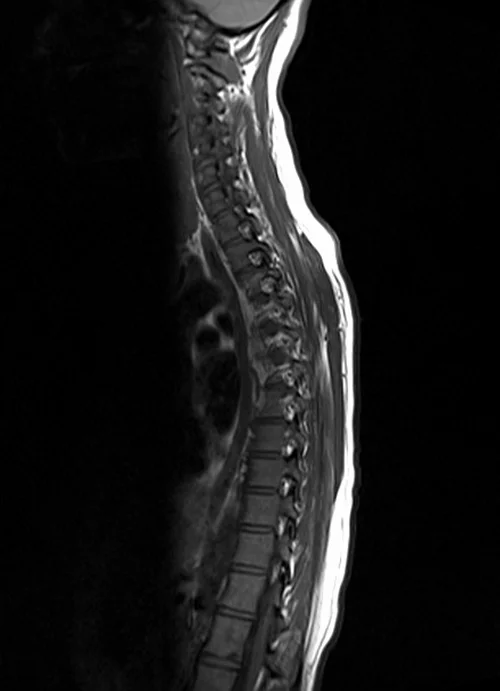 mri t spine sagittal t1 image 3 - MRI