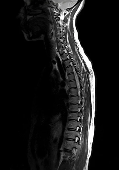 mri t spine sagittal t2 image 1 - MRI