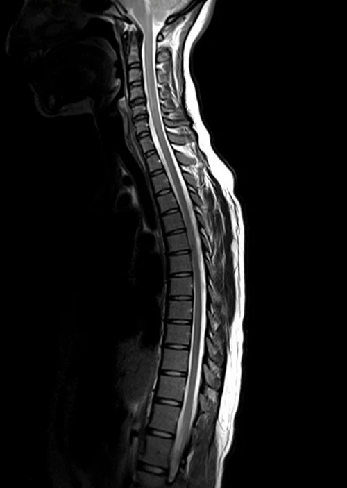 mri t spine sagittal t2 image 2 - MRI