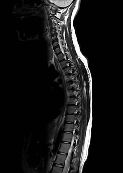 mri t spine sagittal t2 image 3 - MRI