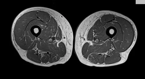 mri thigh axial t1 image 2 - MRI
