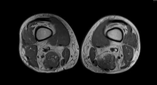 mri thigh axial t1 image 3 - MRI