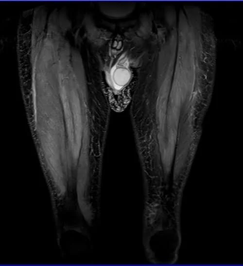 mri thigh coronal stir image 1 - MRI
