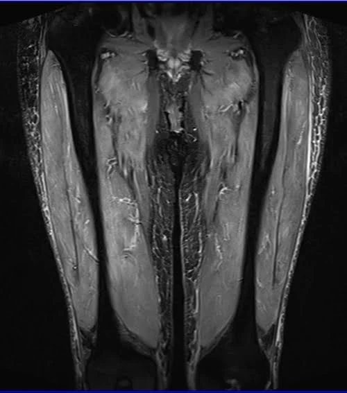 mri thigh coronal stir image 2 - MRI