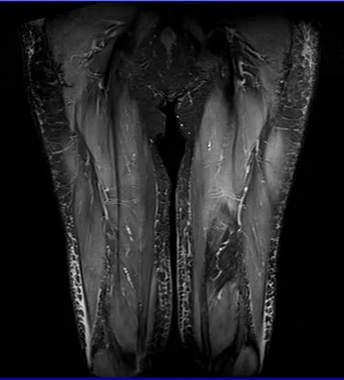 mri thigh coronal stir image 3 - MRI
