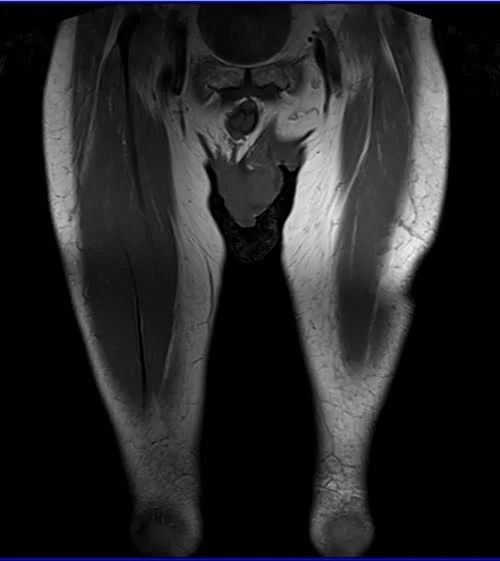 mri thigh coronal t1 image 1 - MRI