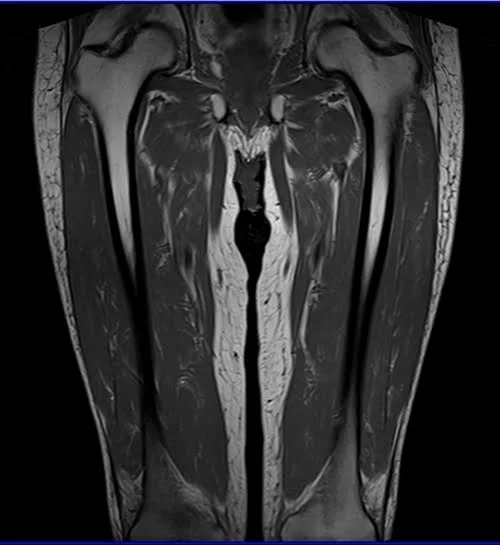mri thigh coronal t1 image 2 - MRI