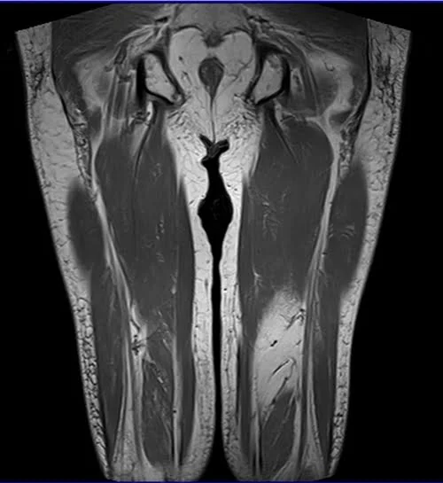 mri thigh coronal t1 image 3 - MRI