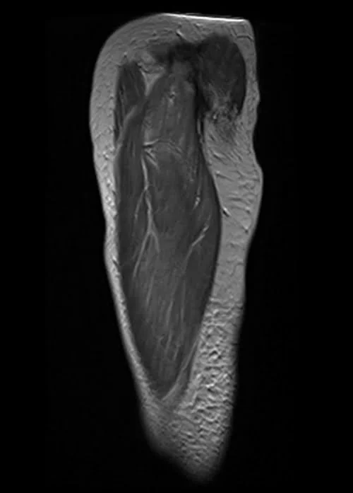 mri thigh sagittal t2 image 1 - MRI