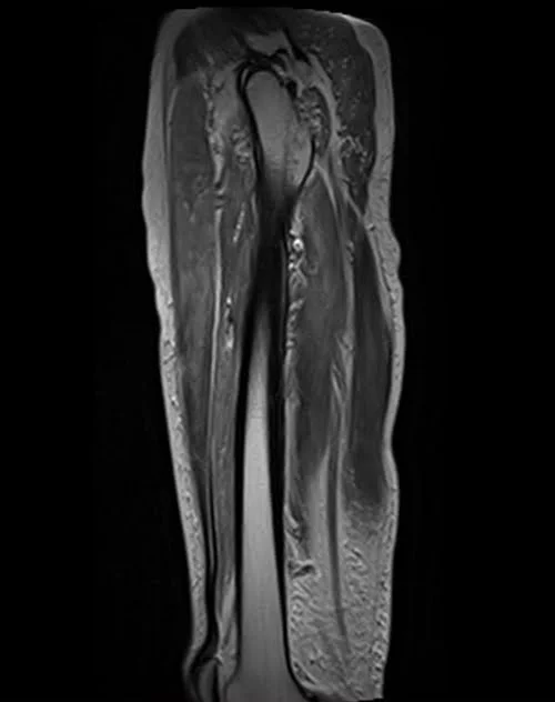 mri thigh sagittal t2 image 2 - MRI