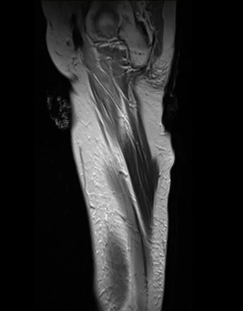 mri thigh sagittal t2 image 3 - MRI