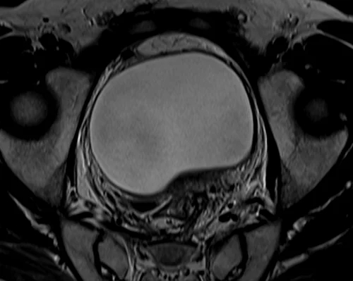 mri urinary bladder axial t2 image 2 - MRI