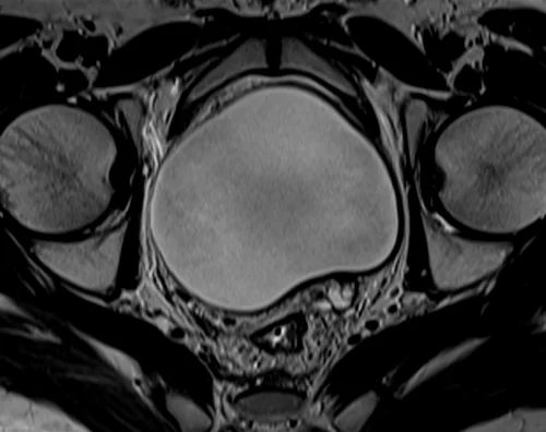 mri urinary bladder axial t2 image 3 - MRI