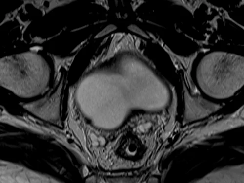 mri urinary bladder axial t2 image 4 - MRI