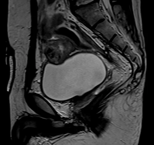 mri urinary bladder sagittal t2 image 2 - MRI