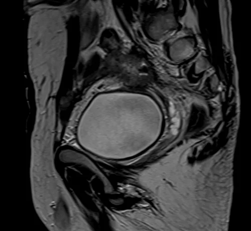 mri urinary bladder sagittal t2 image 3 - MRI