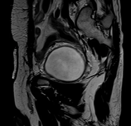 mri urinary bladder sagittal t2 image - MRI