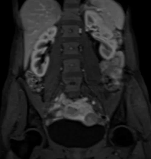 mri urography coronal flash arterial 1 - MRI