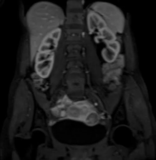 mri urography coronal flash arterial 2 - MRI