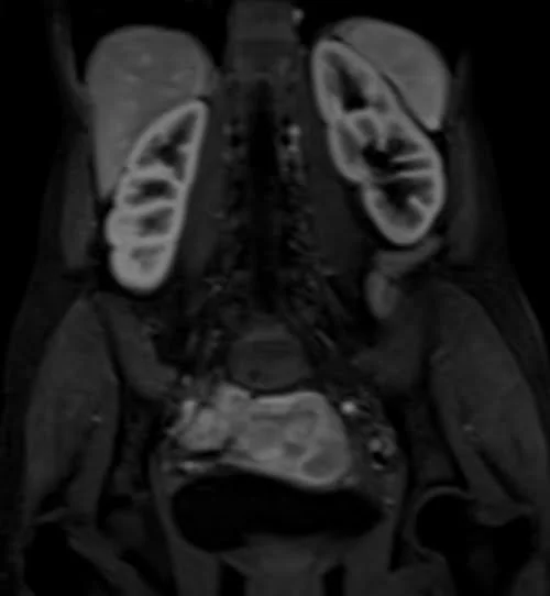 mri urography coronal flash arterial 3 - MRI