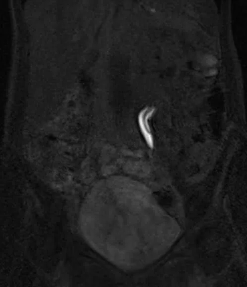 mri urography coronal flash delayed 1 - MRI