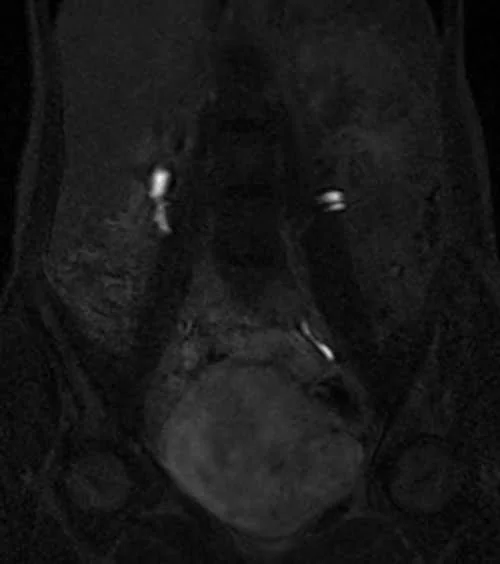 mri urography coronal flash delayed 2 - MRI