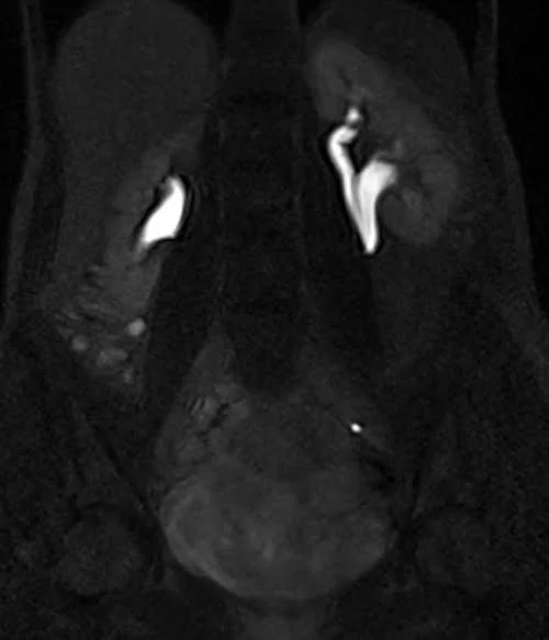 mri urography coronal flash delayed 3 - MRI