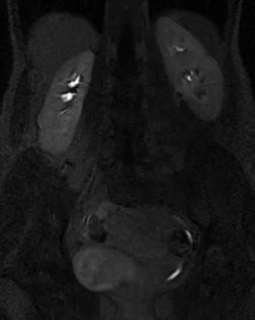 mri urography coronal flash delayed 4 - MRI