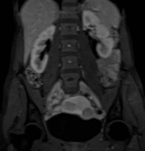 mri urography coronal flash venous 1 - MRI
