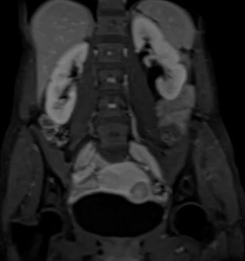 mri urography coronal flash venous 2 (1) - MRI