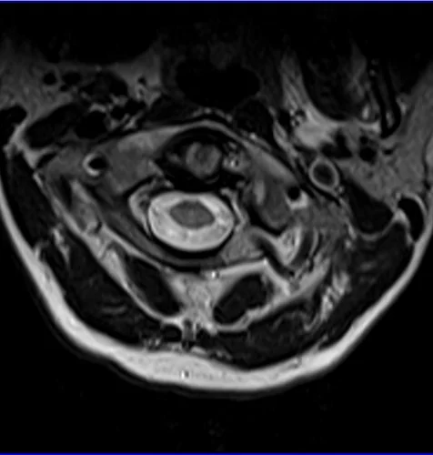 MRI Cervical Spinal Cord T2 Axial Image - MRI Planning