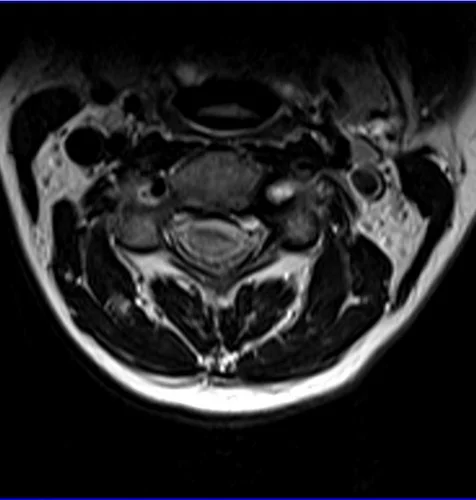 MRI Cervical Spinal Cord T2 Axial Image - MRI Planning