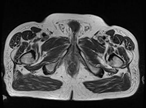 pelvis prostate axial t1 axial image 1 - MRI