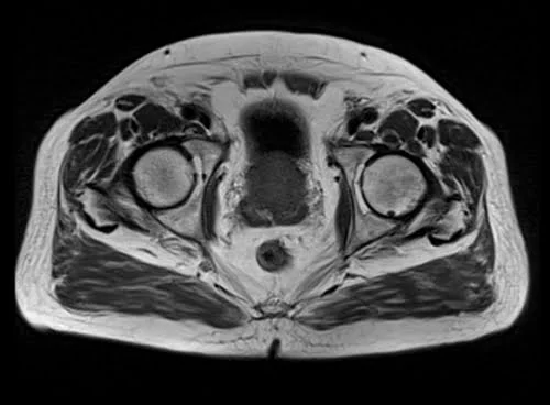 pelvis prostate axial t1 axial image 2 - MRI