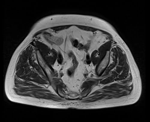 pelvis prostate axial t1 axial image 3 - MRI