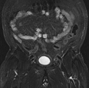 Prostate Coronal View PLAN PROSTATE coronal stir big fov - mrimaster
