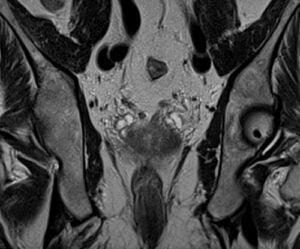 PLAN PROSTATE coronal t2 high res - mrimaster