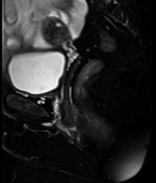 pelvis rectovaginal fistula sagittal t2 fat sat image 1 - MRI