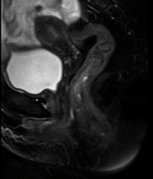 pelvis rectovaginal fistula sagittal t2 fat sat image 3 - MRI