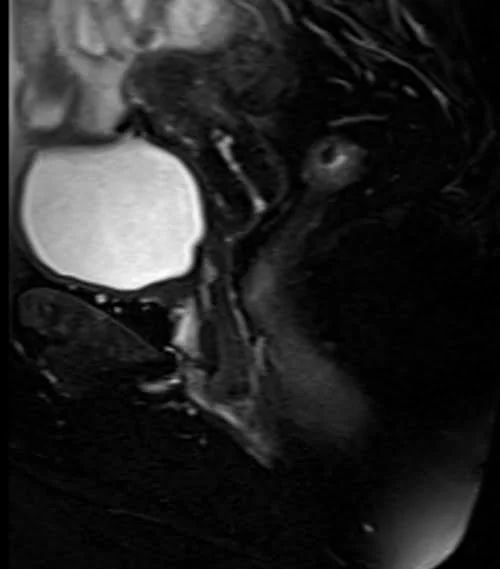 pelvis rectovaginal fistula sagittal t2 fat sat image 4 - MRI