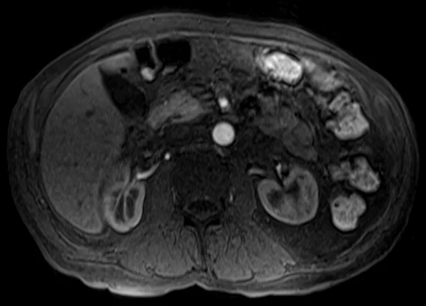 post art t1 5 - MRI